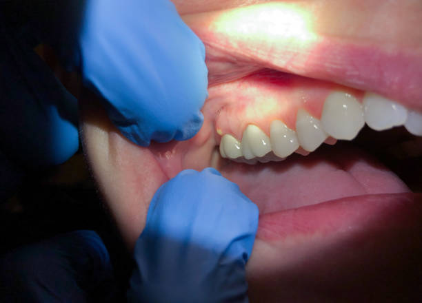 Best Broken or Cracked Tooth Emergency Dentist in Ogden Dunes, IN